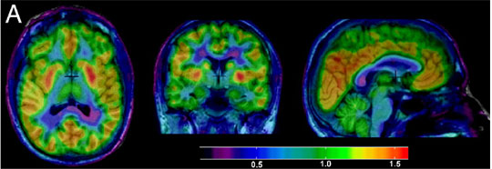 Resonance of the Brain